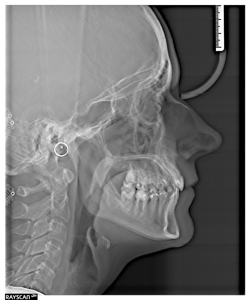 Zdjęcie rentgenowskie cefalometryczne boczne